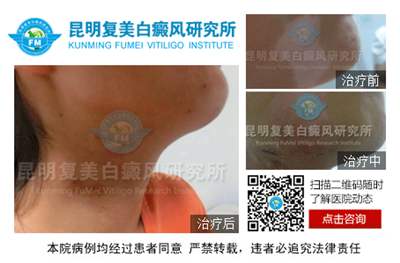 昆明复美白癜风研究所